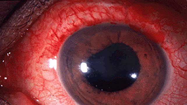 4067 Uveitis 642x361 anterior uveitis slide1