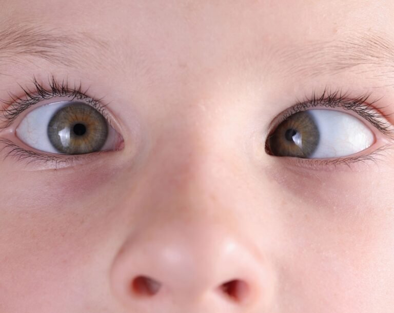 Estrabismo Definicion y tratamiento