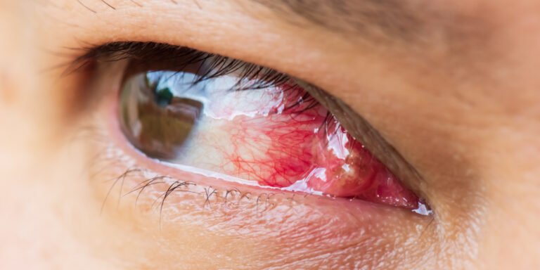 cirugia de pterigion