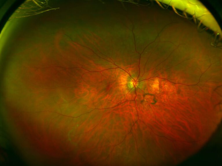 desprendimiento de vitreo posterior1 scaled 1