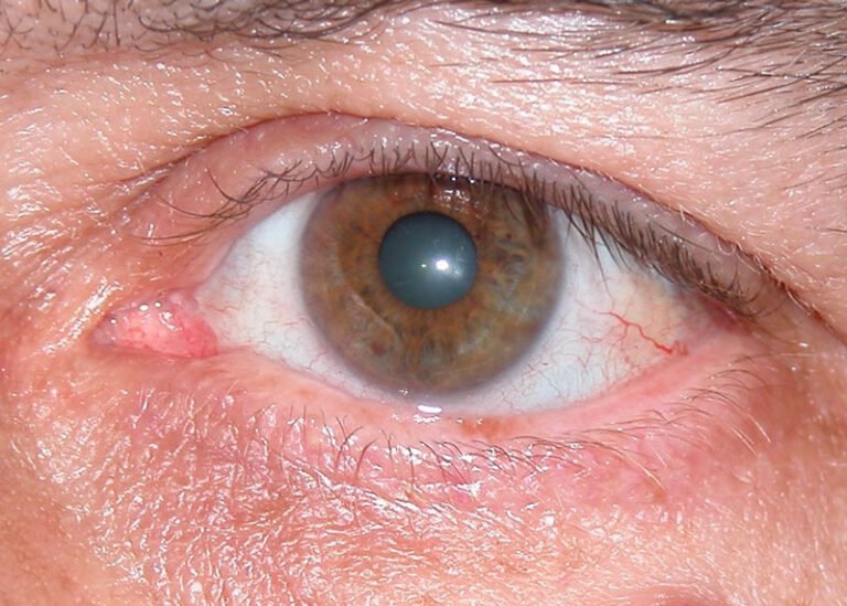 glaucoma de angulo abierto tratamiento 1