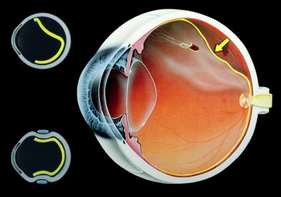 desprendimiento retina