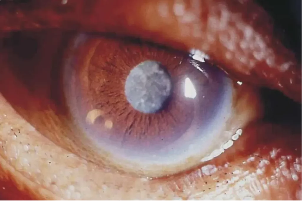 paciente con catarata