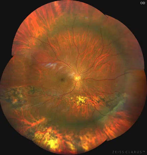 scleral buckle in inferior retinal detachment