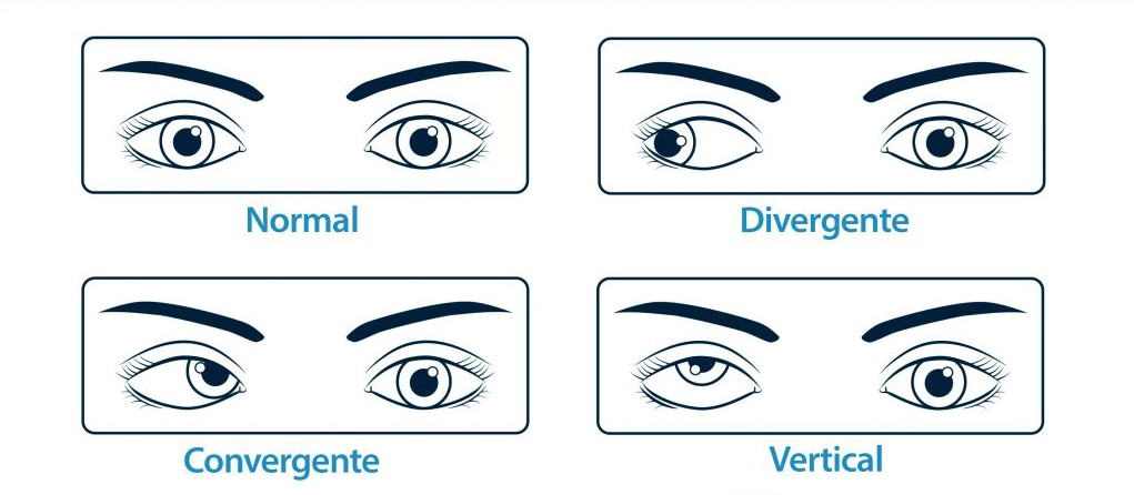 Tipos de estrabismo infantil: esotropia, exotropia, hipertropía